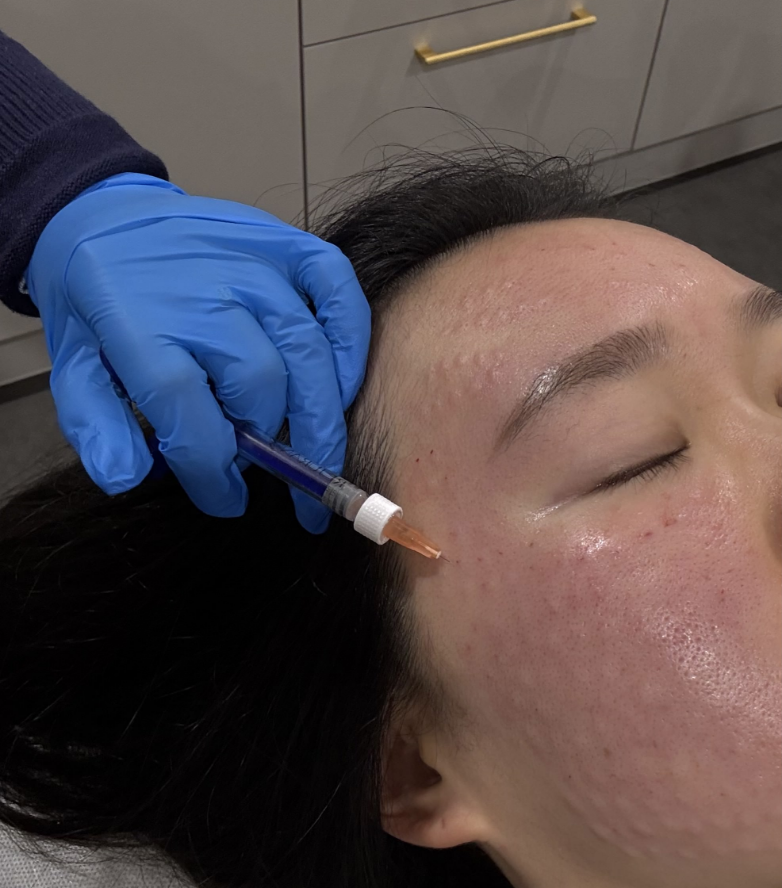 Mesotherapy And Polynucleotide injections